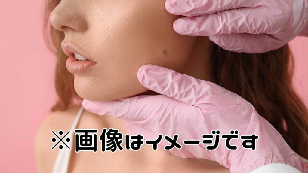 左の頬にホクロがある白人女性の画像。